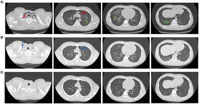 Case report: Severe pneumonia and pneumomediastinum in a previously robust adolescent caused by Omicron BA.5.2